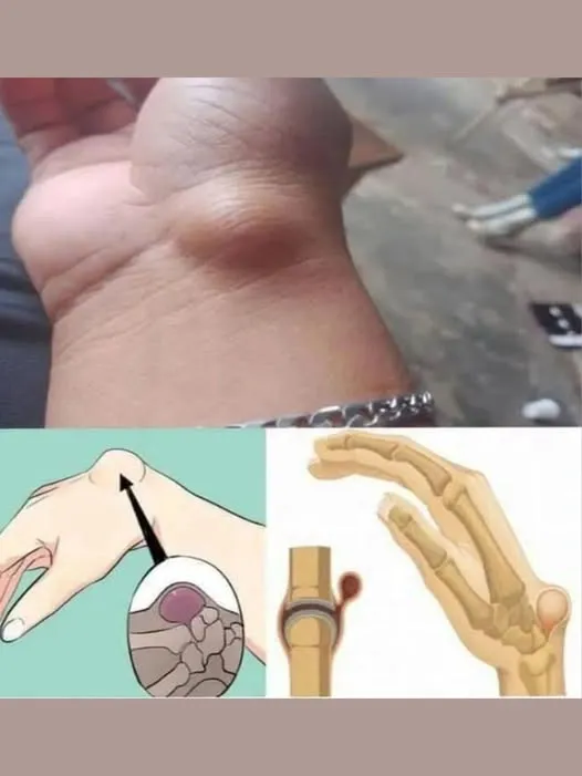 X If You Get These Bruises on Your Body, It Might Mean Something Serious